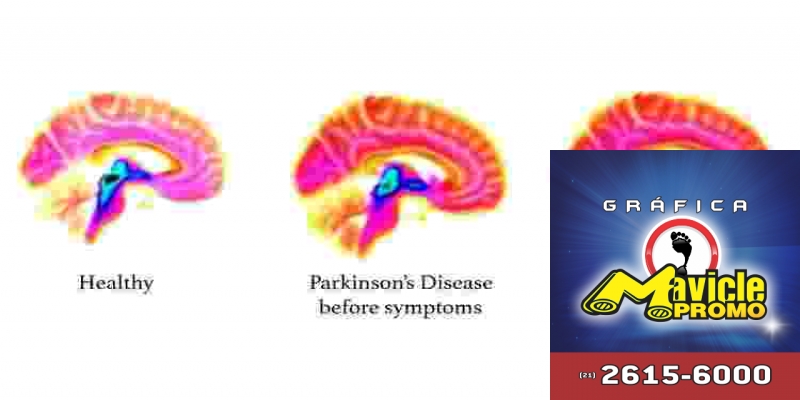 Os sinais da doença de Parkinson que aparecem no cérebro dos 20 anos de idade, antes que os sintomas de